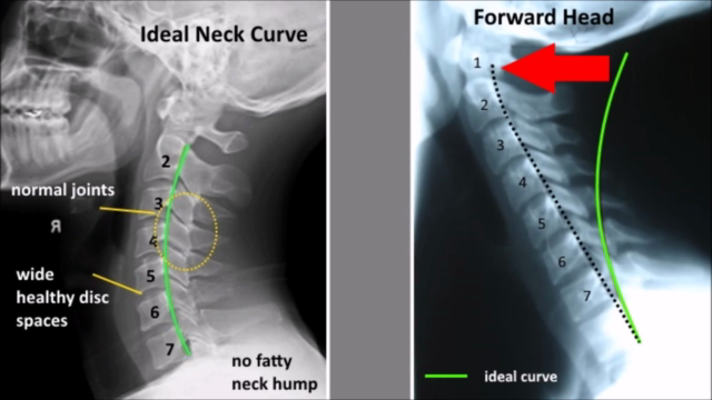 Text Neck | Pain Relief Stretches and Exercises - Screenshot_01