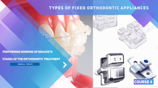 Fixed appliances treatment and bonding in orthodontics – Screenshot 2