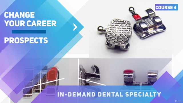 Fixed appliances treatment and bonding in orthodontics – Screenshot 3