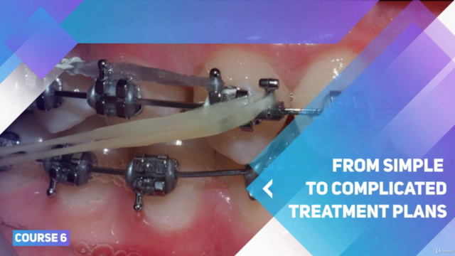 Orthodontic biomechanics and anchorage – Screenshot 3