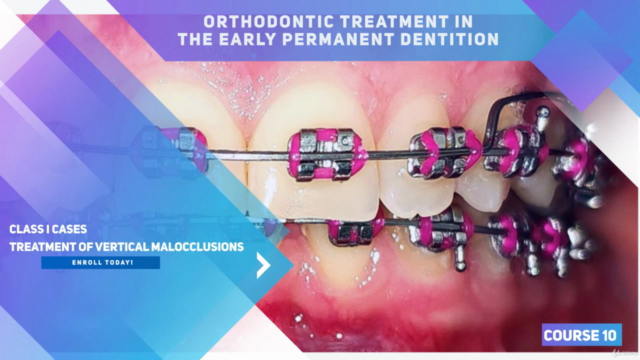 Orthodontic Treatment in the Early Permanent Dentition – Screenshot 2