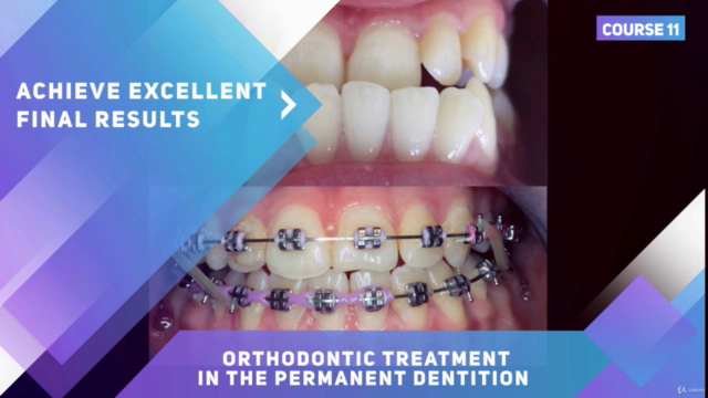 Orthodontic treatment in the transverse and sagittal planes – Screenshot 2