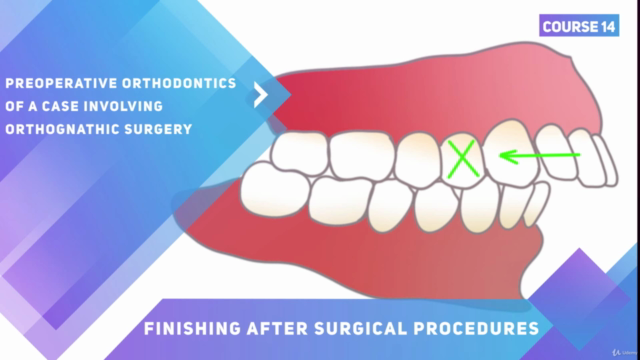 Surgery Procedures in Orthodontics. Cleft Lip and Palate. – Screenshot 2