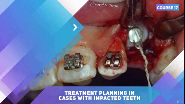 Orthodontic Treatment of Impacted Teeth – Screenshot 2