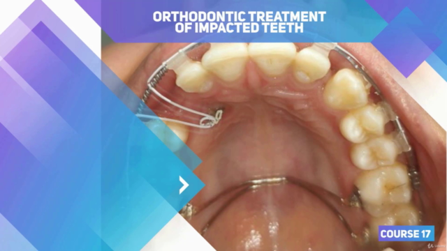 Orthodontic Treatment of Impacted Teeth – Screenshot 3