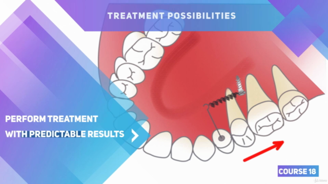 Mini Implants in Orthodontics – Screenshot 2