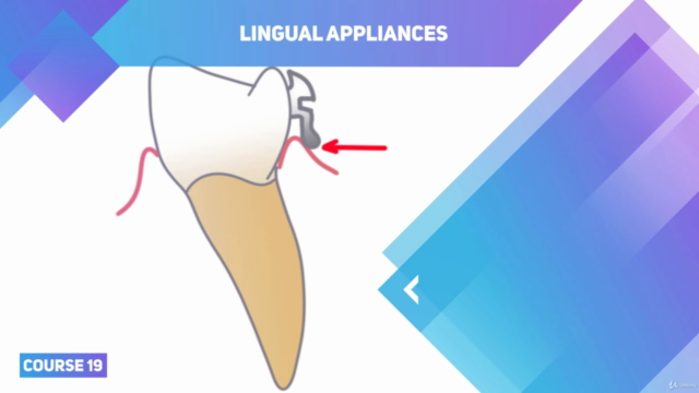 Lingual Orthodontics. Construction of Appliance & Treatment – Screenshot 3