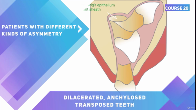 Orthodontics of Dilacerated, Ankylosed and Transposed Teeth – Screenshot 2