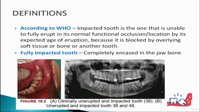 Extraction of Impacted Third Molar – Screenshot 2