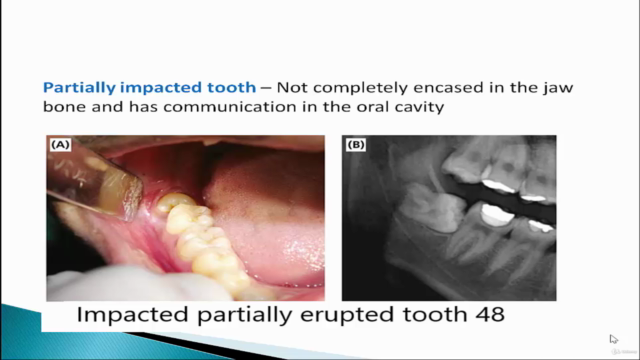 Extraction of Impacted Third Molar – Screenshot 4