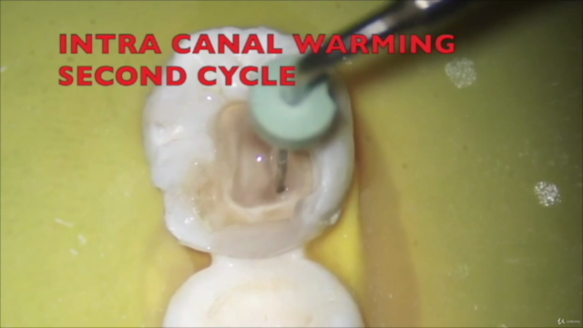 Shaping for Cleaning in Endodontics – Screenshot 3