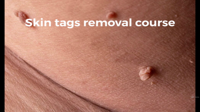 Skin tags,Dark Spot Removal Course for Aestheticians – Screenshot 1