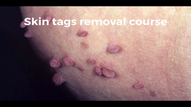 Skin tags,Dark Spot Removal Course for Aestheticians – Screenshot 2