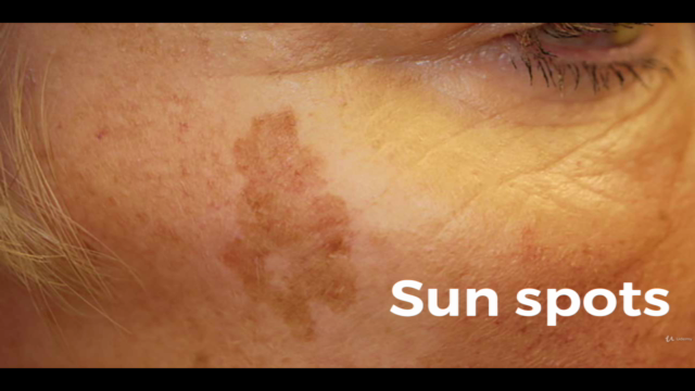 Skin tags,Dark Spot Removal Course for Aestheticians – Screenshot 3