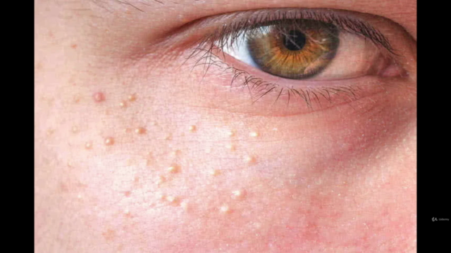Skin tags,Dark Spot Removal Course for Aestheticians – Screenshot 4