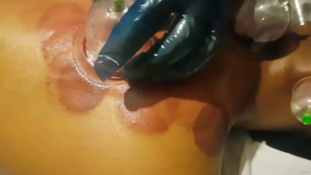 Certified Hijama Therapy:The Prophetic Sunnah Cupping Course – Screenshot 3