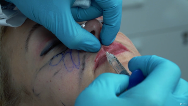 Fillers: Hyaluronic acid injections from plastic surgeon! – Screenshot 4