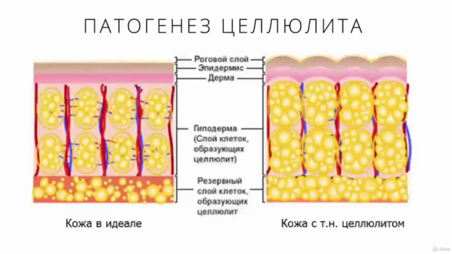 Антицеллюлитный моделирующий массаж – Screenshot 1