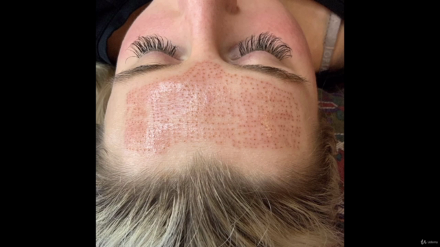 Plasmapen-Fibroblast treatment for aestheticians – Screenshot 3