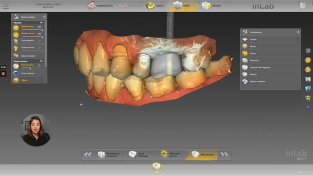 CAD CAM Corona sobre implante con Inlab 20 Dentsply Sirona – Screenshot 1