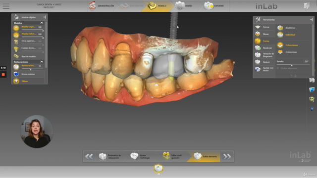 CAD CAM Corona sobre implante con Inlab 20 Dentsply Sirona – Screenshot 3