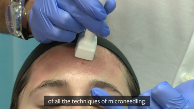 Microneedling – A Guide to Collagen Induction Therapy – Screenshot 2