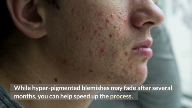 How to Get Rid of Acne and Acne Scars Fast With Home Remedie - Screenshot_03
