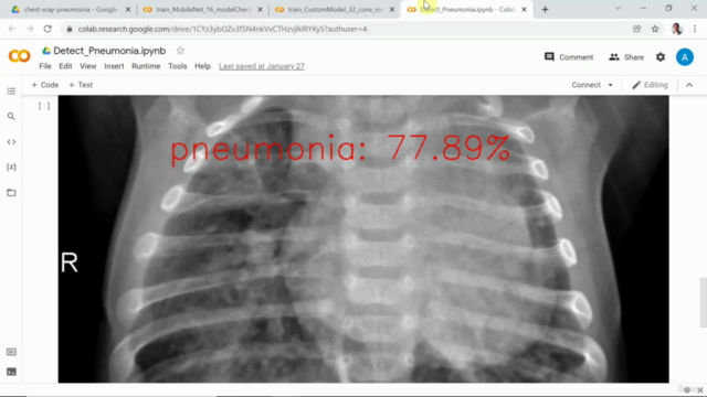 Data Science: CNN & OpenCV : Chest XRAY-Pneumonia Detection – Screenshot 4