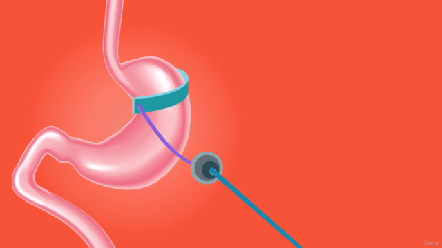 Perdre du poids avec la pose d'anneau gastrique hypnotique – Screenshot 3