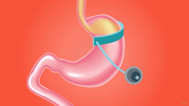 Perdre du poids avec la pose d'anneau gastrique hypnotique – Screenshot 4