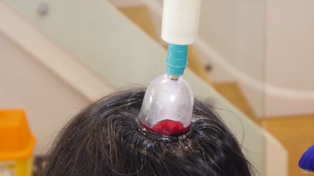 Professional Hijama and dry cupping therapy course – Screenshot 4