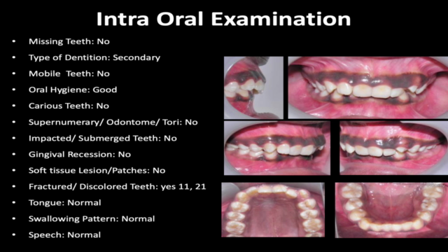 Deep Bite Malocclusion – Screenshot 1
