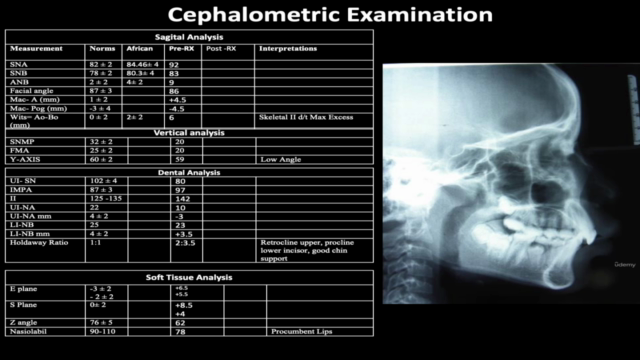 Deep Bite Malocclusion – Screenshot 2