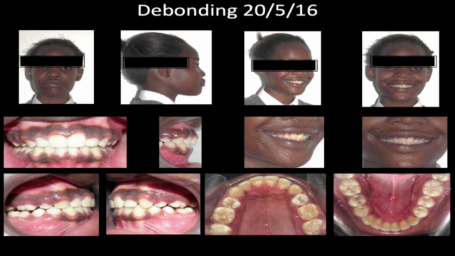 Deep Bite Malocclusion – Screenshot 4