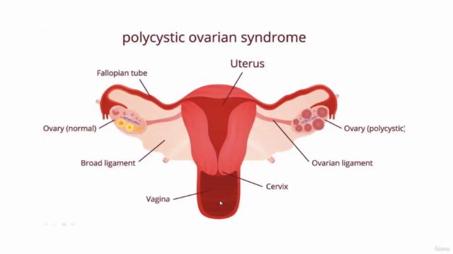 PCOS (Polycystic Ovary Syndrome) & PCOD Master Class (TM) – Screenshot 2