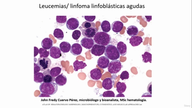 Aprende leucemia/linfoma linfoblástica aguda – Screenshot 1