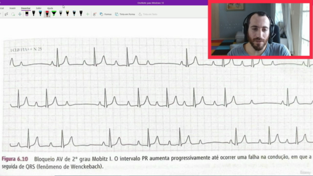 Curso de eletrocardiograma 2.0 , as principais alterações – Screenshot 2