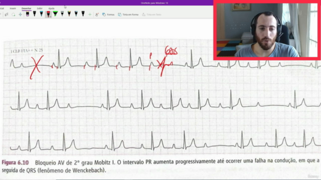 Curso de eletrocardiograma 2.0 , as principais alterações – Screenshot 4