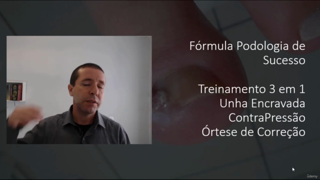 Como Desencravar Unhas , Órtese e Técnica de Contra Pressão – Screenshot 2