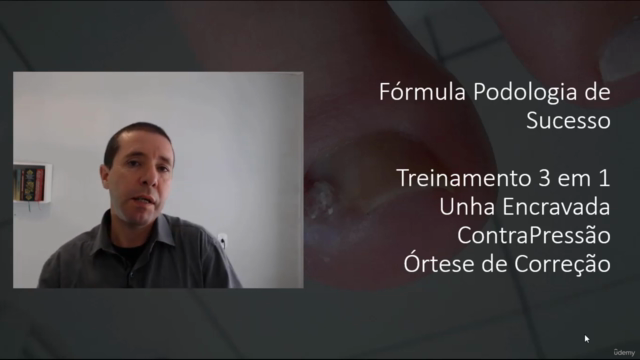Como Desencravar Unhas , Órtese e Técnica de Contra Pressão – Screenshot 3