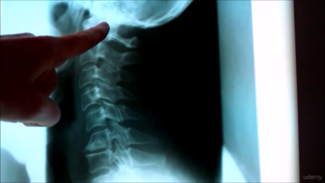 Neck Hump| How to Get Rid of the Fat at the Top of Your Back – Screenshot 3